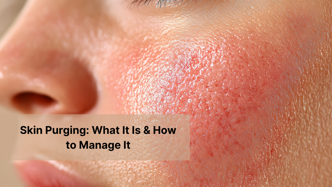 Skin Purging: What It Is & How to Manage It?