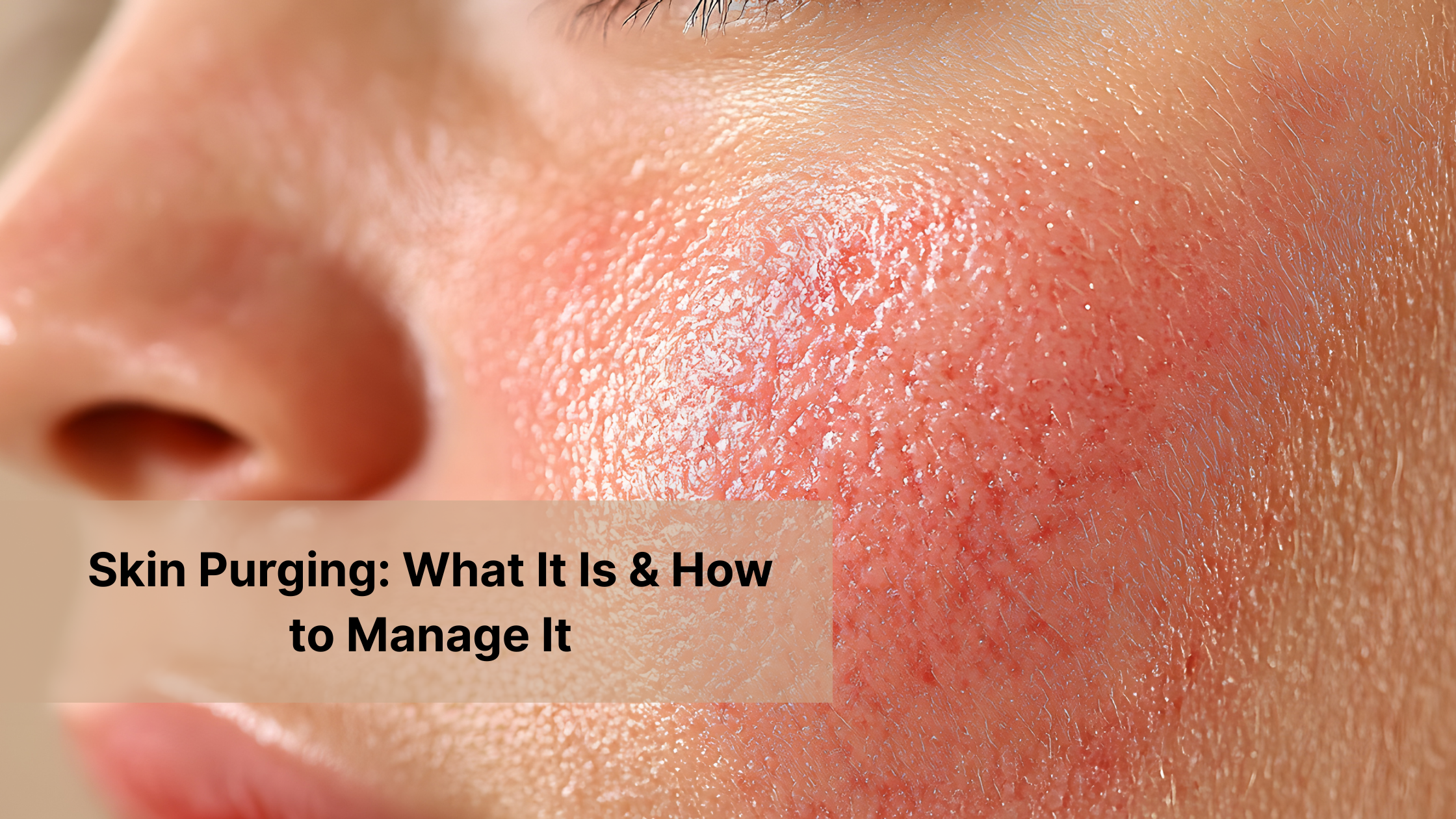 Skin Purging: How to Manage Breakouts – Cathy Doll Store
