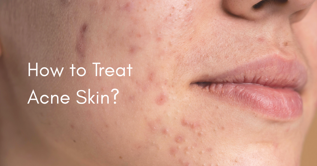 How to Treat Acne Without Drying Out Your Skin